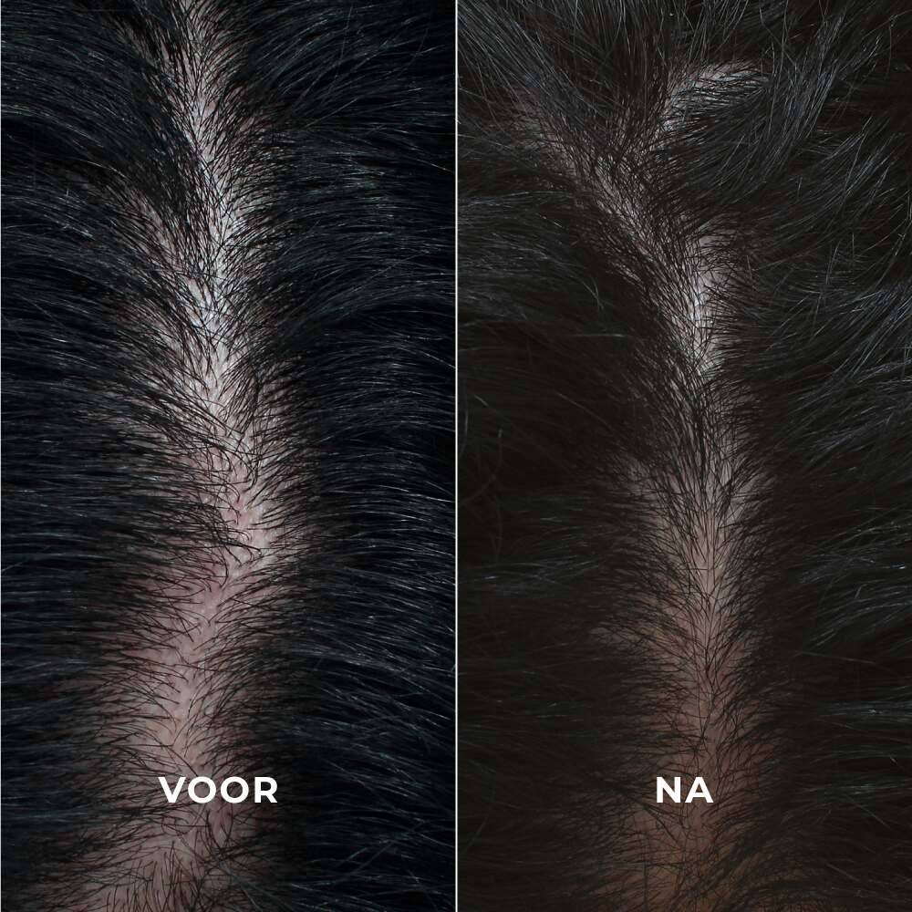 Intensieve haarverdikkende behandeling